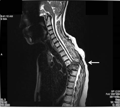 Spinal cord compression is usually secondary to an extrinsic mass. . Spinal cord flattening vs compression
